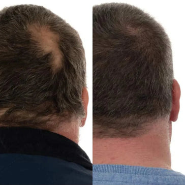 Foligain hårvækstbehandling (mænd) Foligain hair growth treatment (men) - Hairgivers