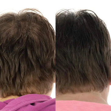 Foligain tratamento para o crescimento do cabelo (mulheres) Foligain hair growth treatment (women) - Hairgivers