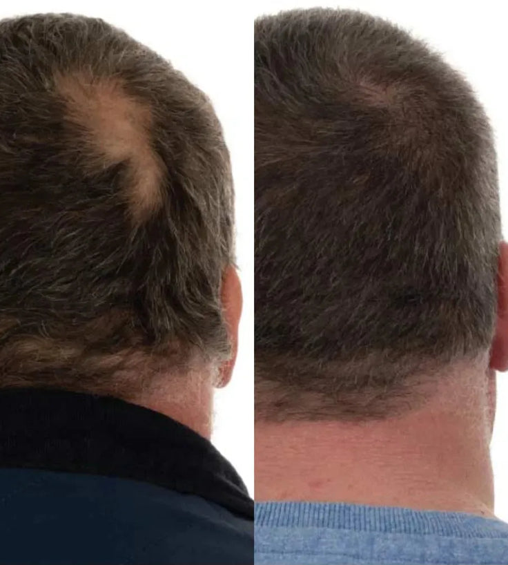 Foligain hair loss shampoo men (236 ml) - Hairgivers
