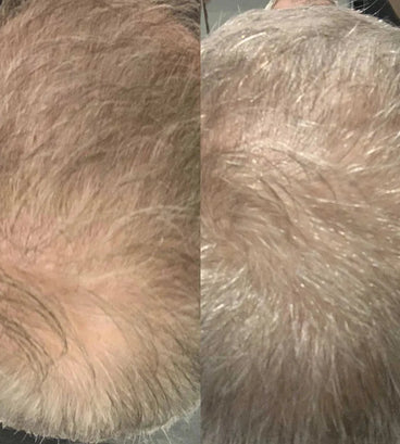 Scandinavian Biolabs Bio-Pilixin serum men (100 ml) - Hair Growth Specialist