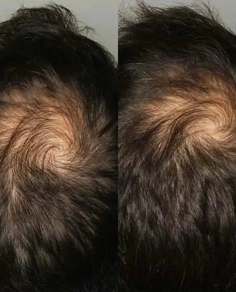 Viviscal hair growth tablets for men (3 months) - Hairgivers